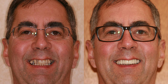 Smile gallery before after picture