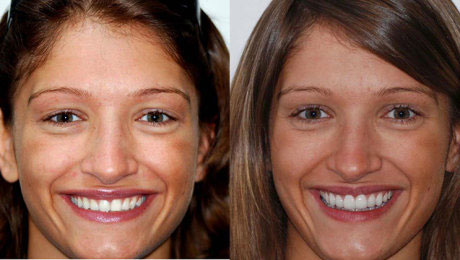 Smile gallery before after picture