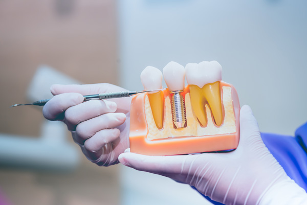 Image of a dental professional pointing to a dental implant model, at Stephen L Ruchlin DDS in Rochester, NY.