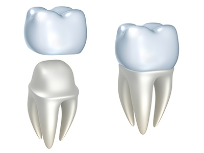 Image of a dental crown at Stephen L Ruchlin DDS in Rochester, NY.