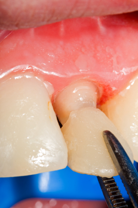 Image of a dental crown being placed at Stephen L Ruchlin DDS in Rochester, NY.