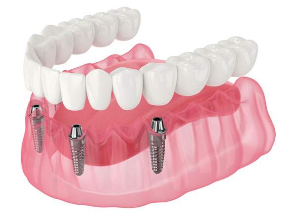 Rendering of All on X dental implants in the lower jaw.