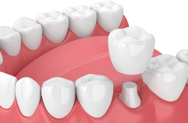 Rendering of jaw with dental crown at Stephen L Ruchlin DDS in Rochester, NY