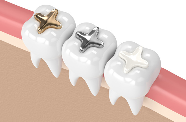 Rendering of teeth with 3 filling materials