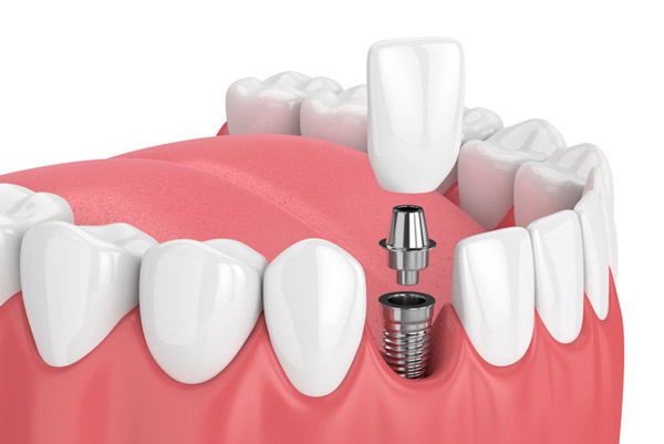 Diagram of dental implant placement at Stephen L Ruchlin DDS.