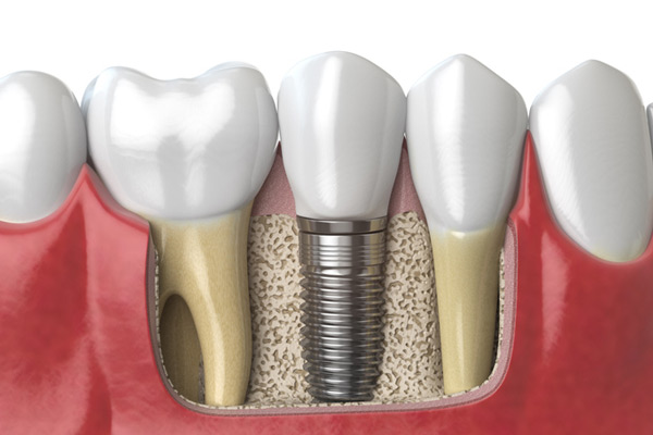 3D rendering of a dental implant next to healthy teeth Stephen L Ruchlin DDS in Rochester, NY