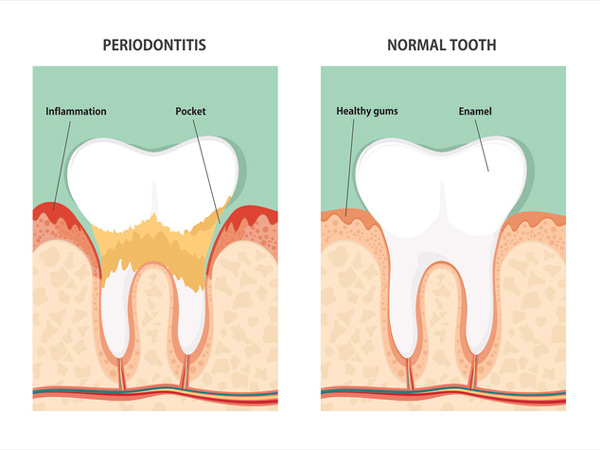 Diagram of periodontitis and health tooth at Stephen L Ruchlin DDS in Rochester, NY