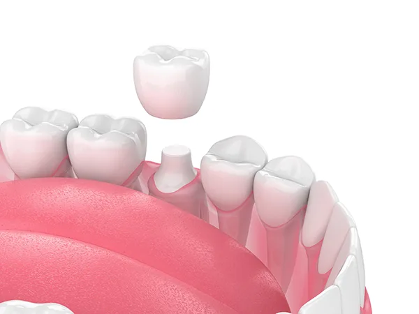 Close up 3D rendering of a shaved down tooth being capped with a porcelain dental crown