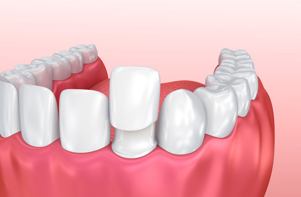 Rendering of jaw with porcelain veneer on tooth Stephen L Ruchlin DDS in Rochester, NY