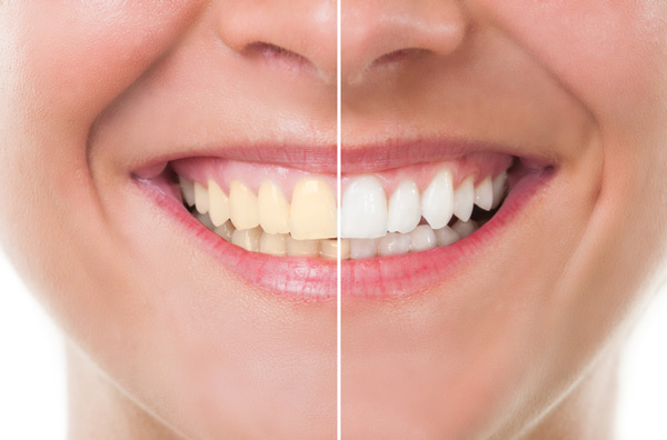 Before and after photo of teeth whitening treatment at Stephen L Ruchlin DDS in Rochester, NY