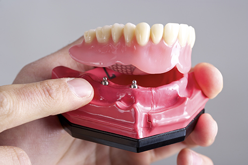 Image of an implant supported denture at Stephen L Ruchlin DDS in Rochester, NY.