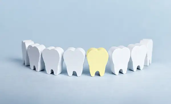 A row of white tooth models with one yellow tooth in the center, symbolizing tooth decay.