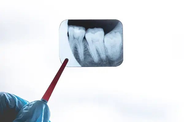 A dental X-ray image pointing to an impacted wisdom tooth pressing against neighboring teeth.
